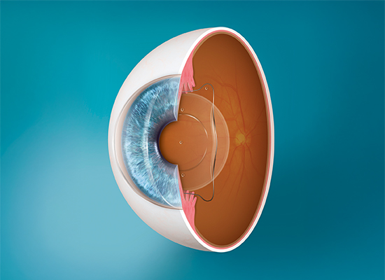 Close-up of an EVO ICL lens showing its size and design used in the eye surgery procedure.