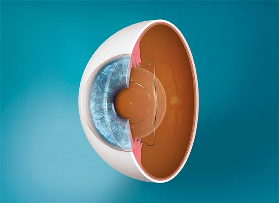Close-up of an EVO ICL lens showing its size and design used in the eye surgery procedure.